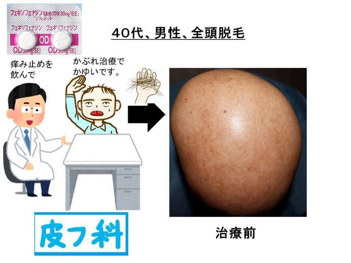 円形脱毛症　病院